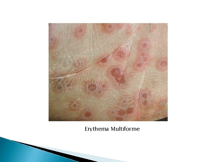 Erythema Multiforme Erythema Multiforme