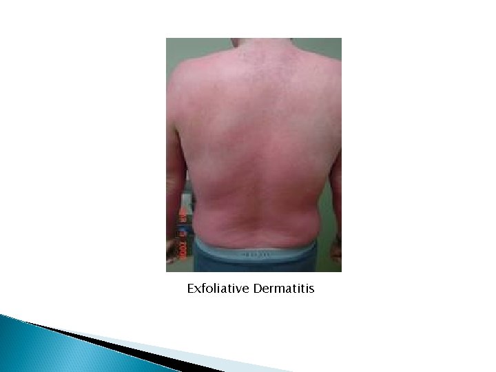 Exfoliative Dermatitis Exfoliative Dermatitis