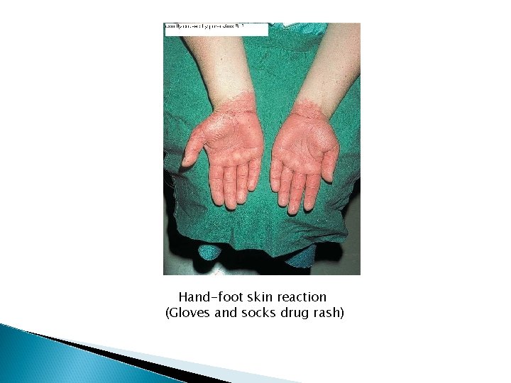 Hand-foot skin reaction (Gloves and socks drug rash) Hand-foot skin reaction (Gloves and socks drug rash)