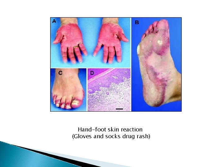 Hand-foot skin reaction (Gloves and socks drug rash) Hand-foot skin reaction (Gloves and socks drug rash)