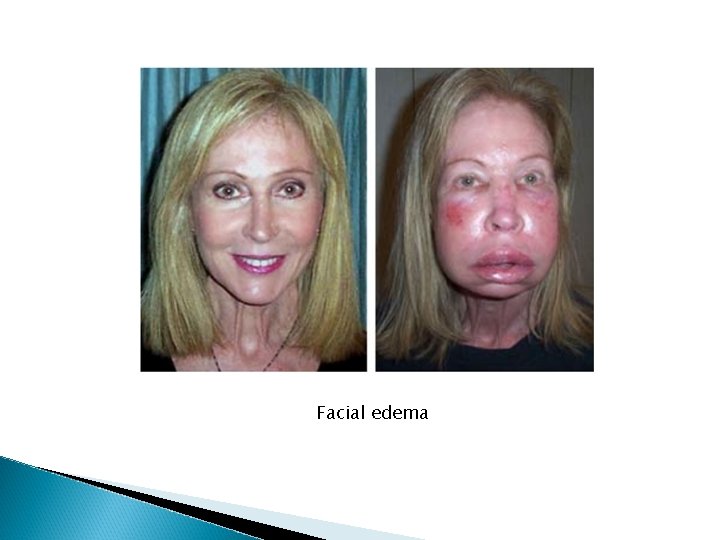 Facial edema Facial edema