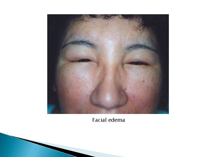Facial edema Facial edema