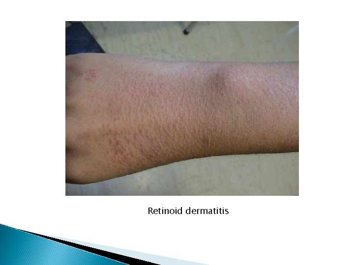 Retinoid dermatitis Retinoid dermatitis