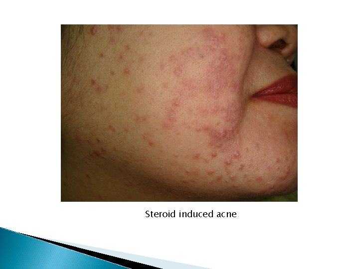 Steroid induced acne Steroid induced acne