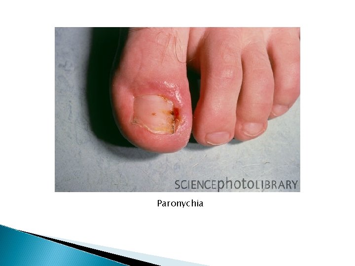Paronychia Paronychia