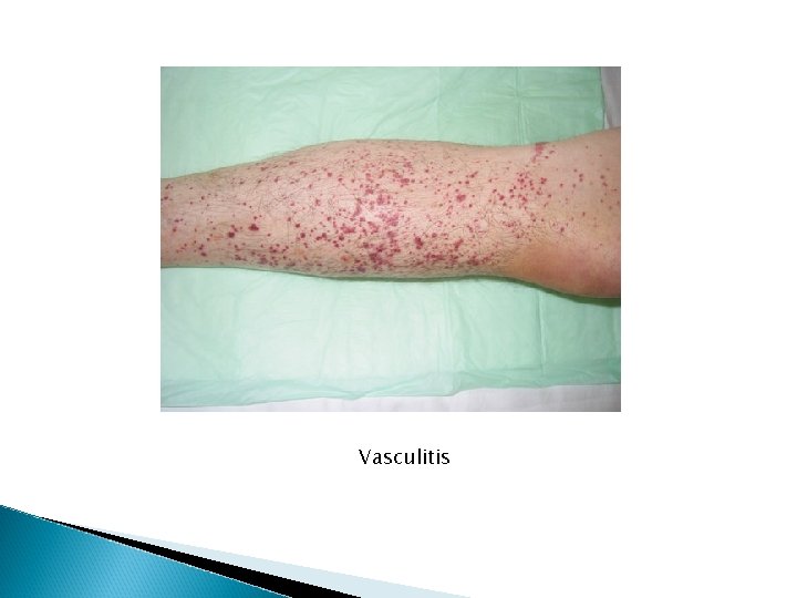 Vasculitis Vasculitis