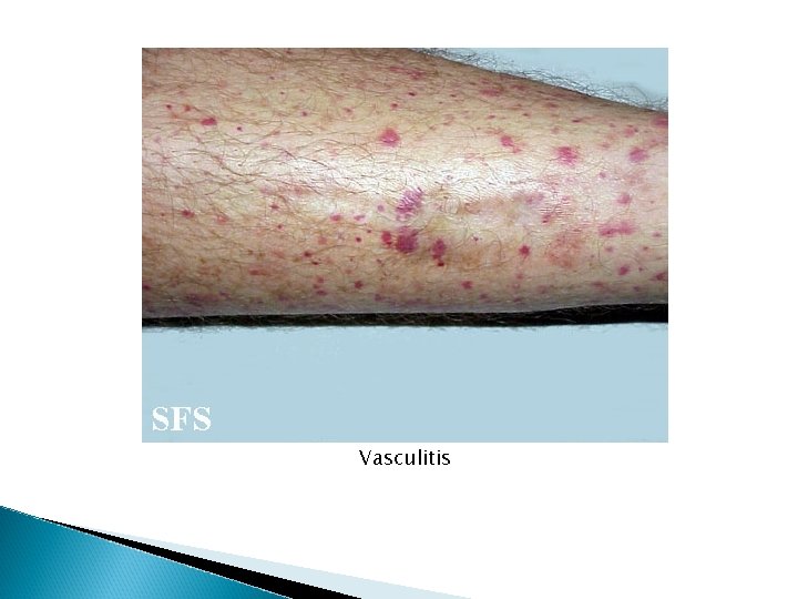 Vasculitis Vasculitis
