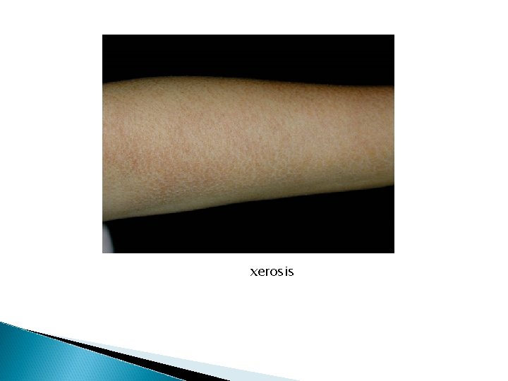 xerosis xerosis