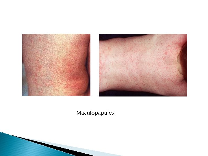 Maculopapules Maculopapules