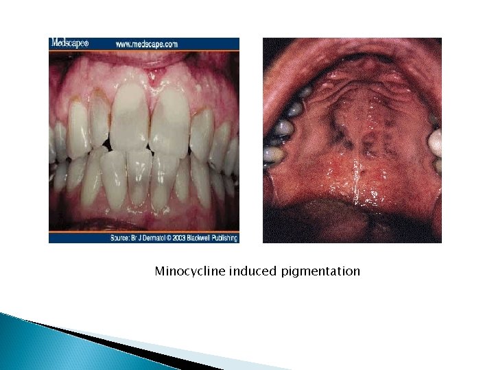 Minocycline induced pigmentation Minocycline induced pigmentation