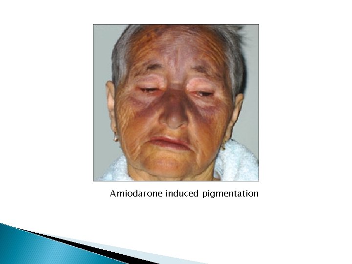 Amiodarone induced pigmentation Amiodarone induced pigmentation