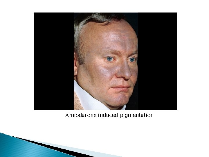 Amiodarone induced pigmentation Amiodarone induced pigmentation