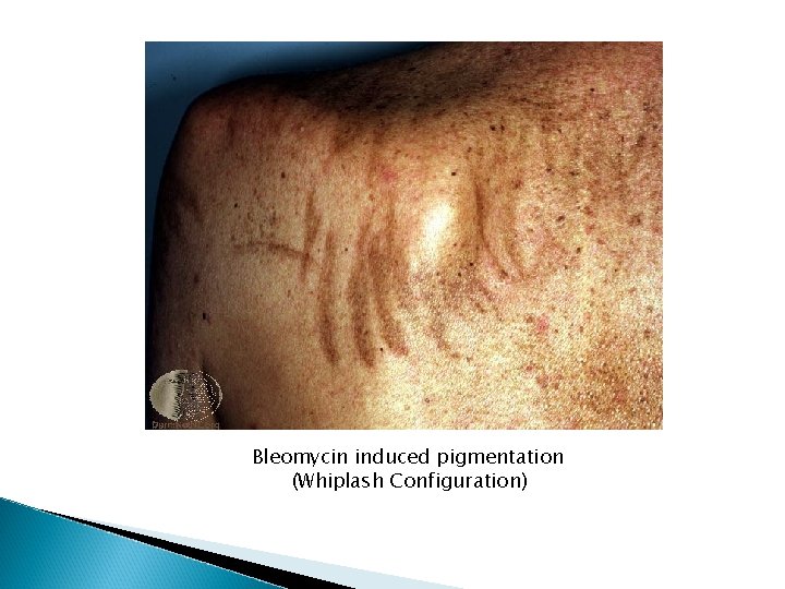 Bleomycin induced pigmentation (Whiplash Configuration) Bleomycin induced pigmentation (Whiplash Configuration)