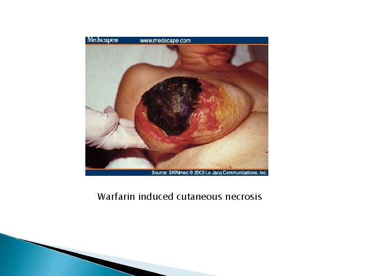 Warfarin induced cutaneous necrosis Warfarin induced cutaneous necrosis