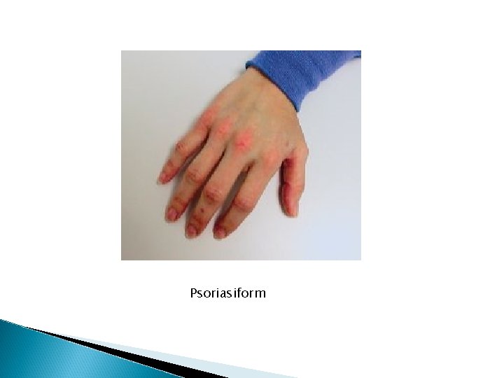 Psoriasiform Psoriasiform