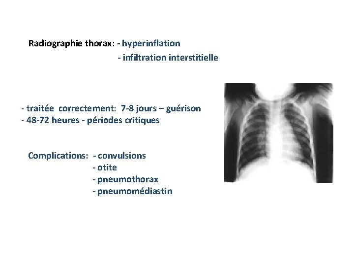 Radiographie thorax: - hyperinflation - infiltration interstitielle Evoluţie: - traitée correctement: 7 -8 jours