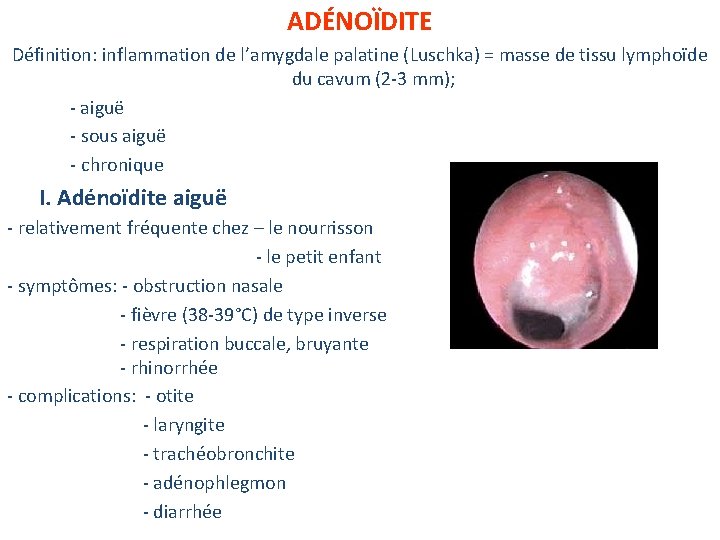 ADÉNOÏDITE Définition: inflammation de l’amygdale palatine (Luschka) = masse de tissu lymphoïde du cavum