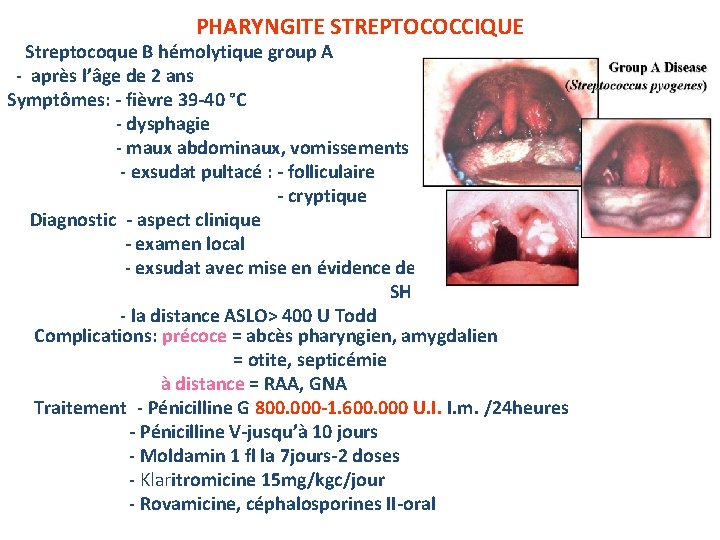 PHARYNGITE STREPTOCOCCIQUE Streptocoque B hémolytique group A - après l’âge de 2 ans Symptômes:
