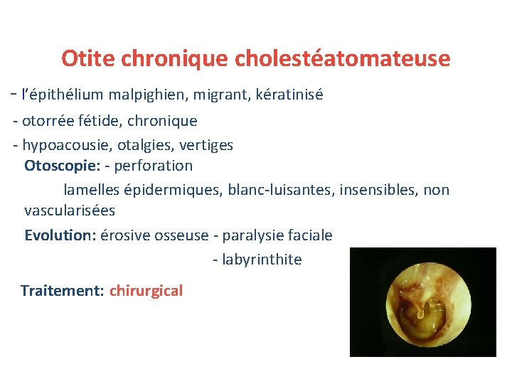 Otite chronique cholestéatomateuse - l’épithélium malpighien, migrant, kératinisé - otorrée fétide, chronique - hypoacousie,