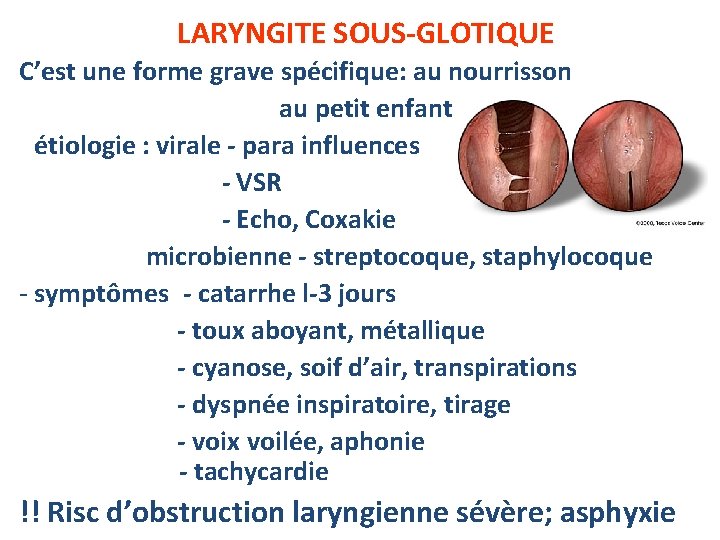 LARYNGITE SOUS-GLOTIQUE C’est une forme grave spécifique: au nourrisson au petit enfant - étiologie