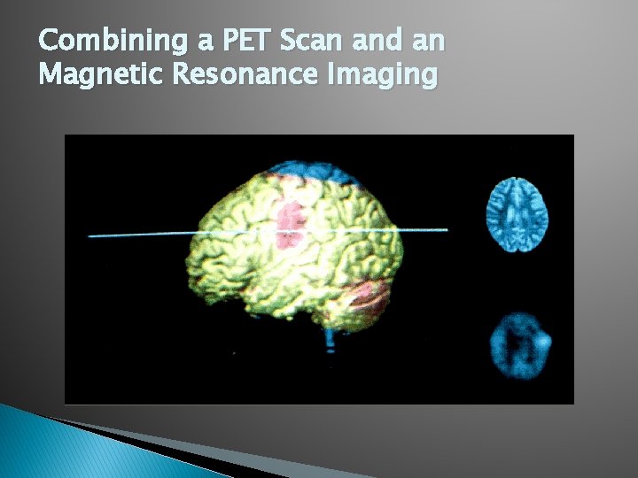 Combining a PET Scan and an Magnetic Resonance Imaging 