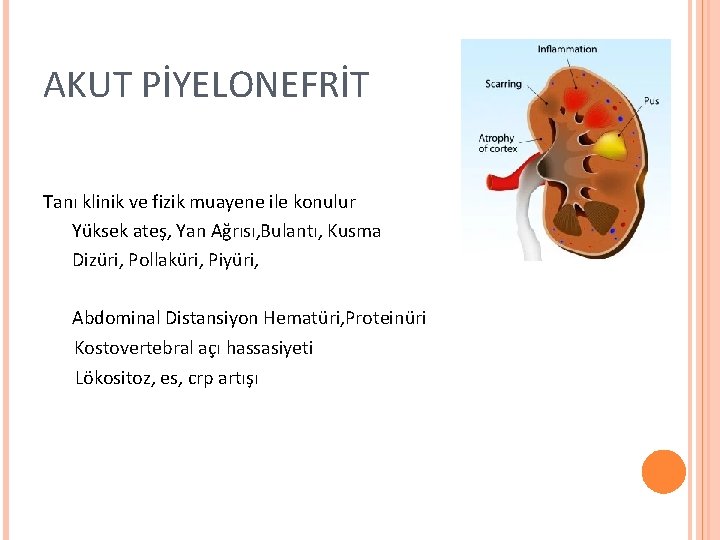 AKUT PİYELONEFRİT Tanı klinik ve fizik muayene ile konulur Yüksek ateş, Yan Ağrısı, Bulantı,