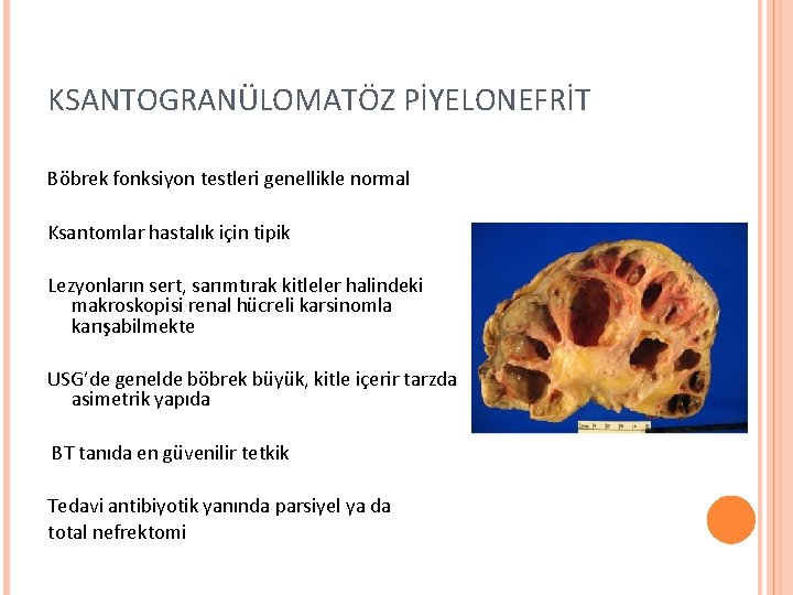 KSANTOGRANÜLOMATÖZ PİYELONEFRİT Böbrek fonksiyon testleri genellikle normal Ksantomlar hastalık için tipik Lezyonların sert, sarımtırak