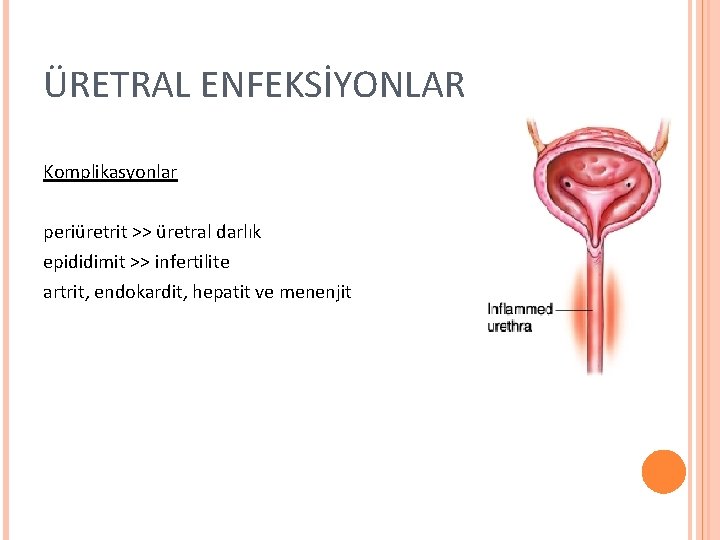 ÜRETRAL ENFEKSİYONLAR Komplikasyonlar periüretrit >> üretral darlık epididimit >> infertilite artrit, endokardit, hepatit ve