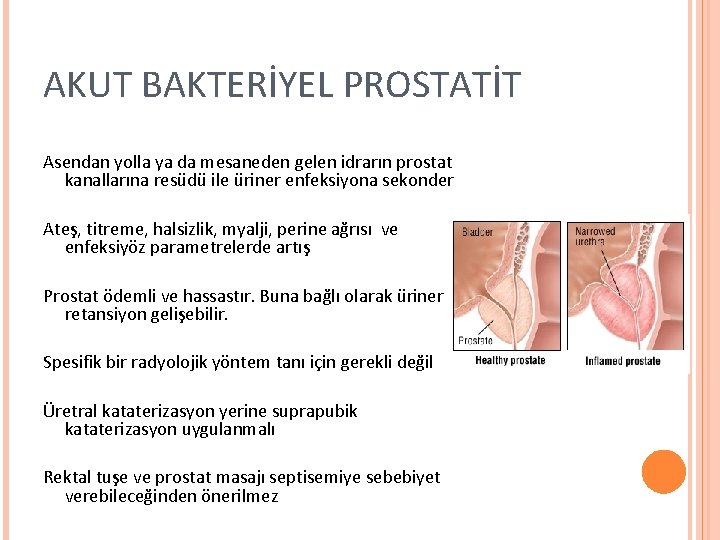 AKUT BAKTERİYEL PROSTATİT Asendan yolla ya da mesaneden gelen idrarın prostat kanallarına resüdü ile