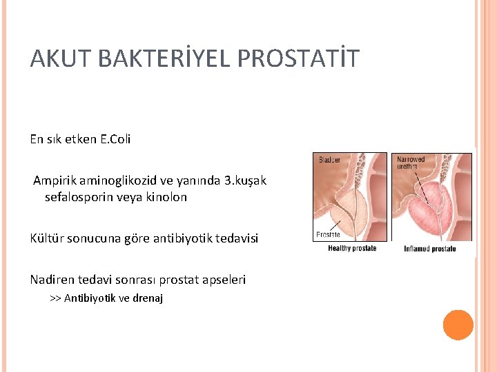 AKUT BAKTERİYEL PROSTATİT En sık etken E. Coli Ampirik aminoglikozid ve yanında 3. kuşak