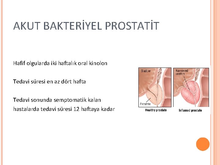 AKUT BAKTERİYEL PROSTATİT Hafif olgularda iki haftalık oral kinolon Tedavi süresi en az dört