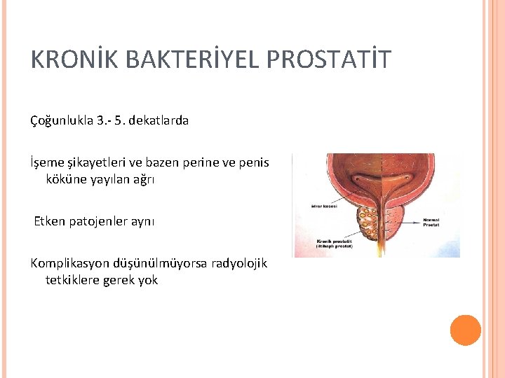 KRONİK BAKTERİYEL PROSTATİT Çoğunlukla 3. - 5. dekatlarda İşeme şikayetleri ve bazen perine ve KRONİK BAKTERİYEL PROSTATİT Çoğunlukla 3. - 5. dekatlarda İşeme şikayetleri ve bazen perine ve