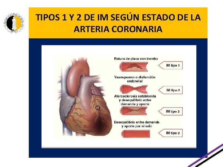 TIPOS 1 Y 2 DE IM SEGÚN ESTADO DE LA ARTERIA CORONARIA. , TIPOS 1 Y 2 DE IM SEGÚN ESTADO DE LA ARTERIA CORONARIA. ,