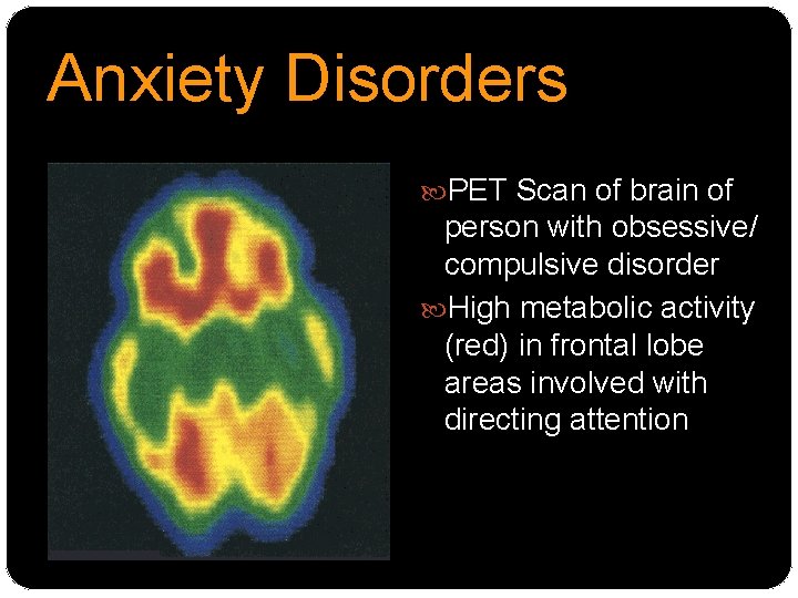 Anxiety Disorders PET Scan of brain of person with obsessive/ compulsive disorder High metabolic