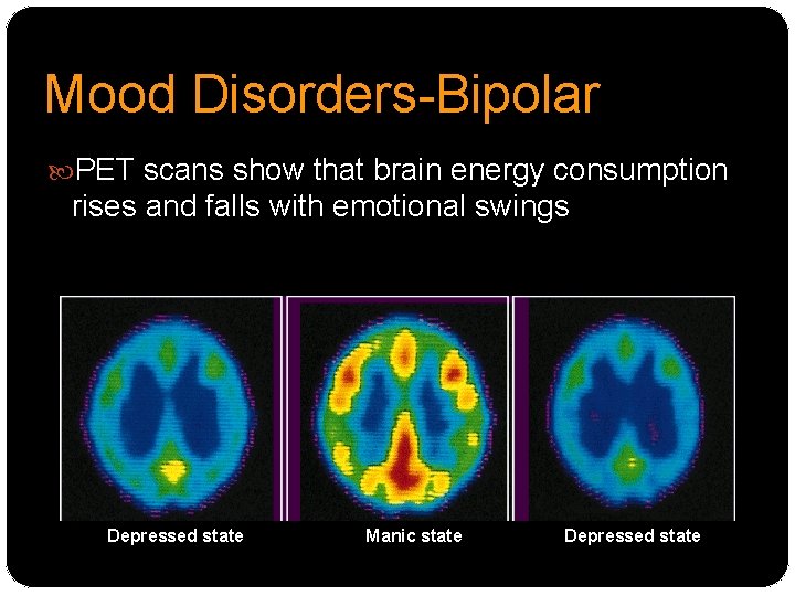 Mood Disorders-Bipolar PET scans show that brain energy consumption rises and falls with emotional