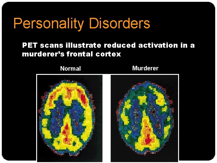 Personality Disorders PET scans illustrate reduced activation in a murderer’s frontal cortex Normal Murderer