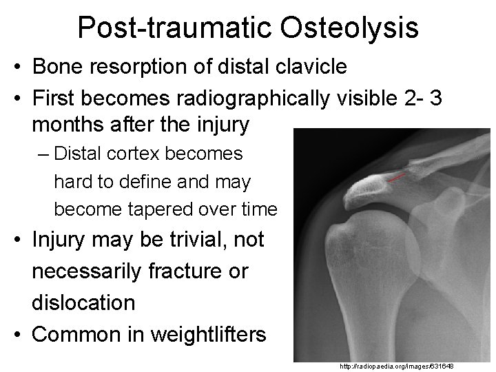 Post-traumatic Osteolysis • Bone resorption of distal clavicle • First becomes radiographically visible 2