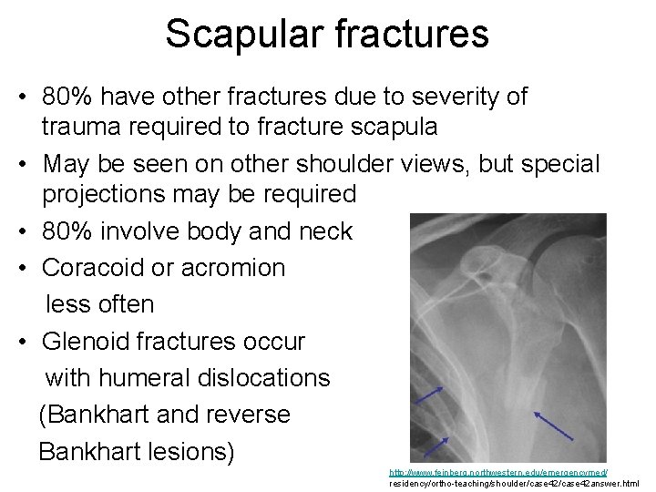 Scapular fractures • 80% have other fractures due to severity of trauma required to