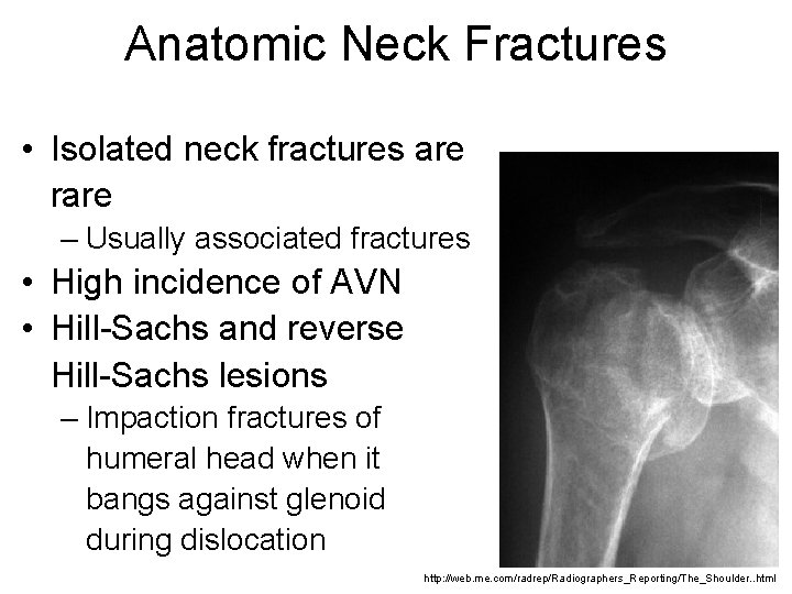 Anatomic Neck Fractures • Isolated neck fractures are rare – Usually associated fractures •