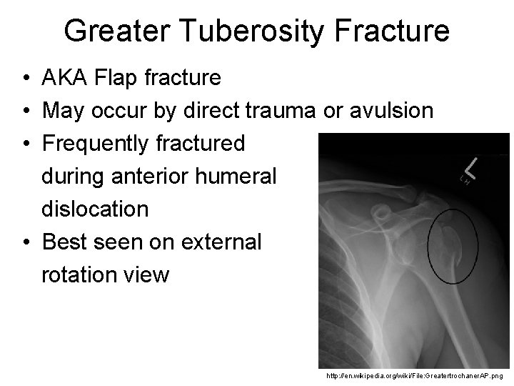 Greater Tuberosity Fracture • AKA Flap fracture • May occur by direct trauma or