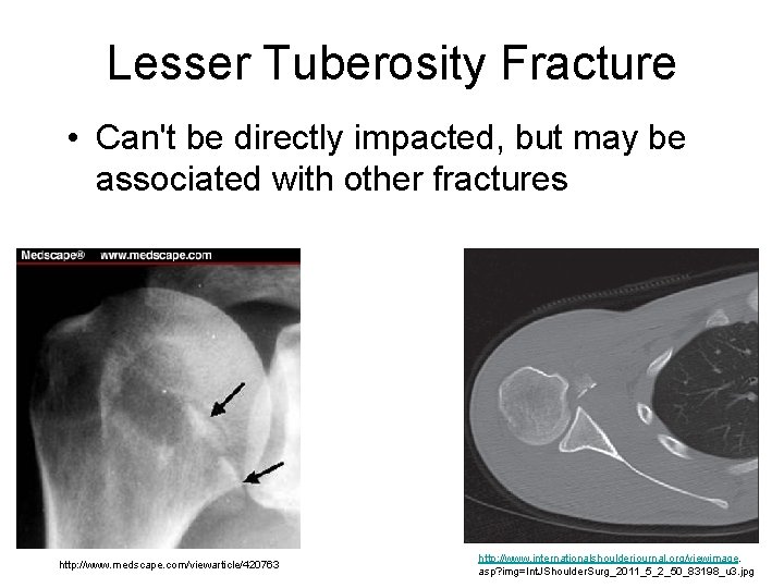 Lesser Tuberosity Fracture • Can't be directly impacted, but may be associated with other