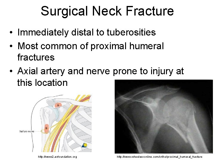 Surgical Neck Fracture • Immediately distal to tuberosities • Most common of proximal humeral