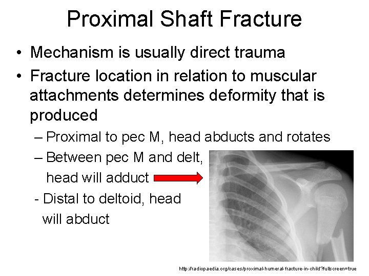 Proximal Shaft Fracture • Mechanism is usually direct trauma • Fracture location in relation