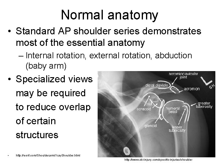 Normal anatomy • Standard AP shoulder series demonstrates most of the essential anatomy –