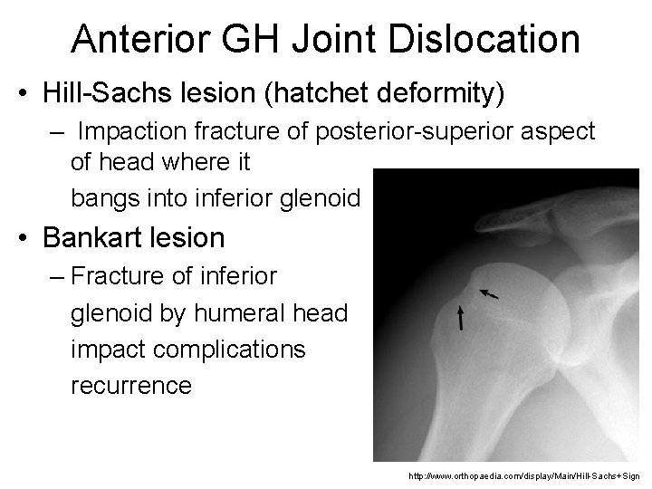 Anterior GH Joint Dislocation • Hill-Sachs lesion (hatchet deformity) – Impaction fracture of posterior-superior