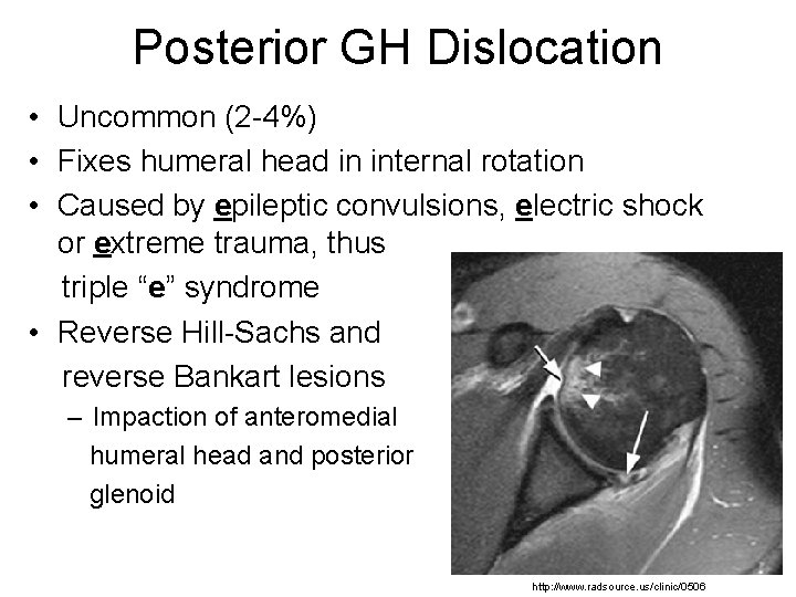 Posterior GH Dislocation • Uncommon (2 -4%) • Fixes humeral head in internal rotation