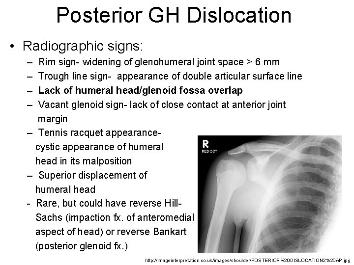 Posterior GH Dislocation • Radiographic signs: – – Rim sign- widening of glenohumeral joint