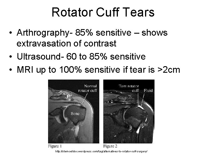 Rotator Cuff Tears • Arthrography- 85% sensitive – shows extravasation of contrast • Ultrasound-