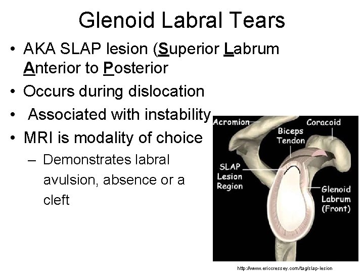 Glenoid Labral Tears • AKA SLAP lesion (Superior Labrum Anterior to Posterior • Occurs