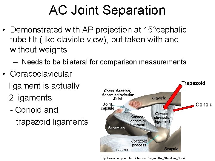 AC Joint Separation • Demonstrated with AP projection at 15°cephalic tube tilt (like clavicle